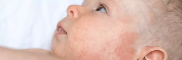mastocytoza skórna u dzieci